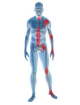 Définition, symptômes et diagnostic de l'arthrose de hanche