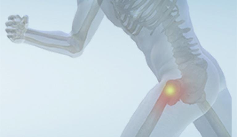 Définition, symptômes et diagnostic de l'arthrose du genou